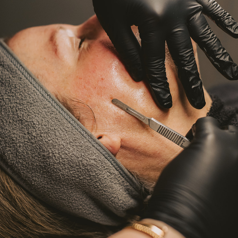 woman having her face dermaplaned
